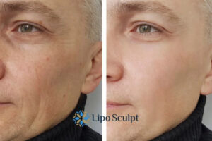 How to Fight Aging Symptoms 3 Fight Aging Symptoms Wales With HIFU and Morpheus8 Today!