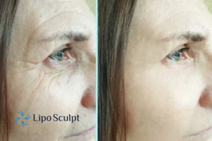 How to Fight Aging Symptoms 2 Do you want to Fight Aging Symptoms Wales? Contact Lipo Sculpt today!