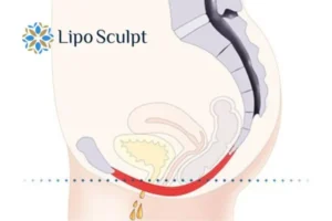Pelvic Floor Chair Therapy 1 Pelvic Floor Chair Therapy Wales to treat incontinence.