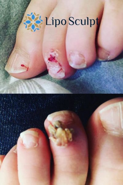 Wart removal customer results from Lipo Sculpt Wales