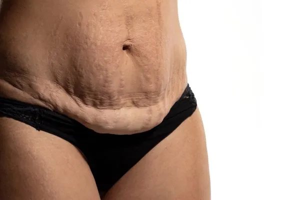 Lost the Weight but Not the Loose Skin? 1 image of womans stomach after weight loss showing loose skin Wales